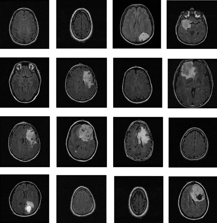 Brain Tumor Project
